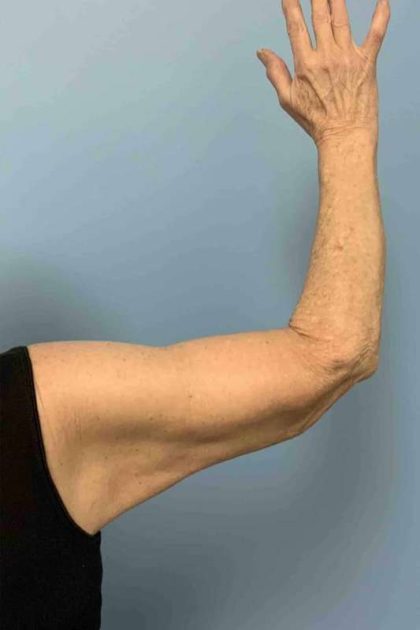 Brachioplasty Before & After Patient #12371