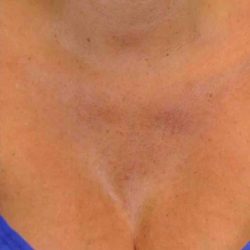 BBL Forever Young Before & After Patient #12381