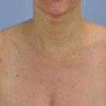 BBL Forever Young Before & After Patient #12389