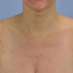 BBL Forever Young Before & After Patient #12389