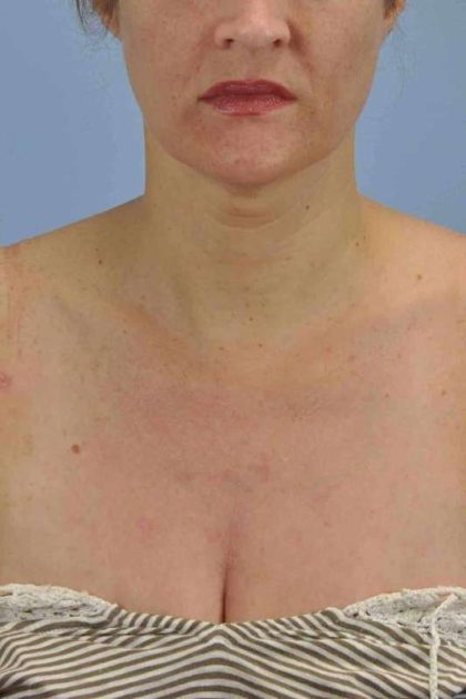 BBL Forever Young Before & After Patient #12389