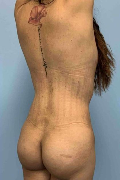 VASER Liposelection Before & After Patient #10416