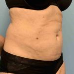VASER Liposelection Before & After Patient #10446