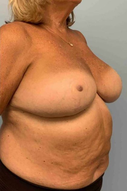 VASER Liposelection Before & After Patient #10466