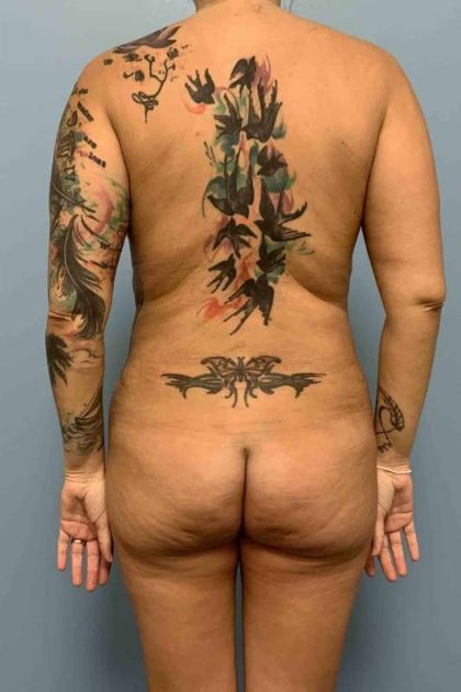 VASER Liposelection Before & After Patient #10479