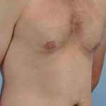 VASER Liposelection Before & After Patient #10486