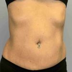 VASER Liposelection Before & After Patient #10407