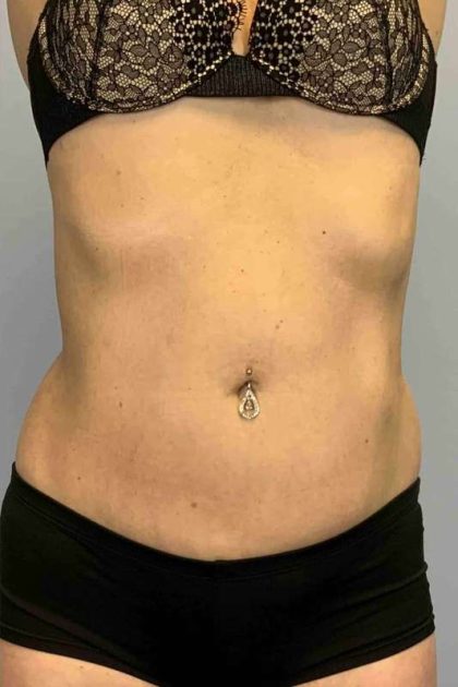 VASER Liposelection Before & After Patient #10407