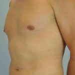 VASER Liposelection Before & After Patient #10527