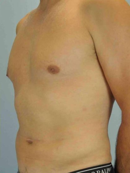 VASER Liposelection Before & After Patient #10527