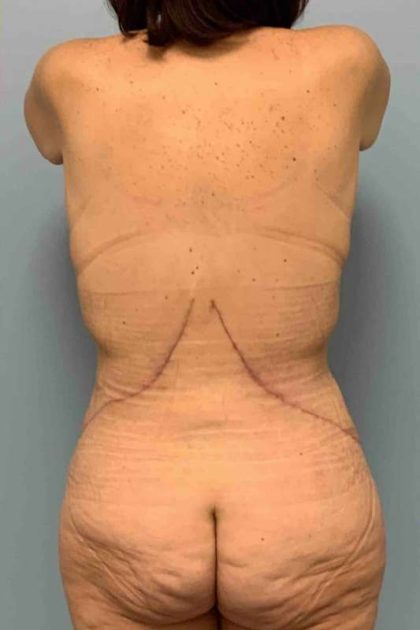 VASER Liposelection Before & After Patient #10561