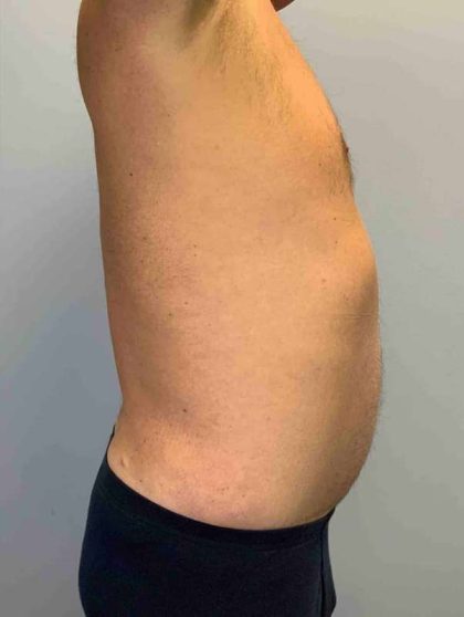 VASER Liposelection Before & After Patient #10575
