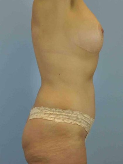 VASER Liposelection Before & After Patient #10593