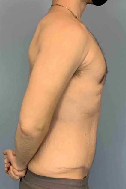 VASER Liposelection Before & After Patient #10602
