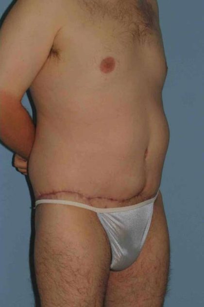 VASER Liposelection Before & After Patient #10400
