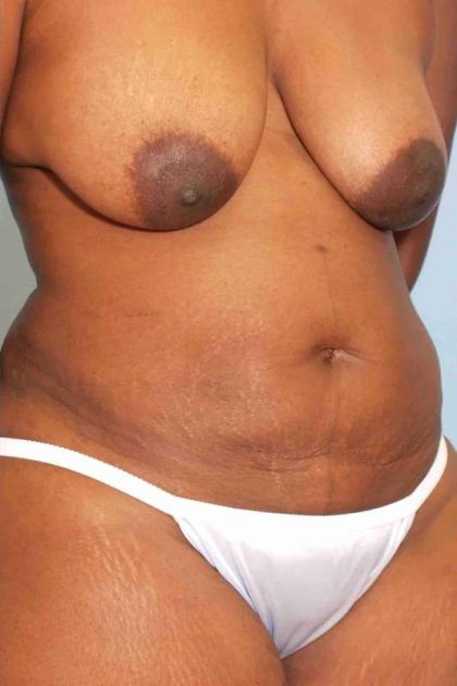 VASER Liposelection Before & After Patient #10631