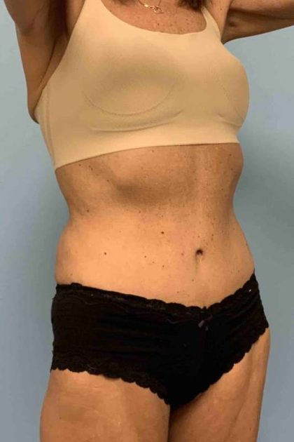 VASER Liposelection Before & After Patient #10638