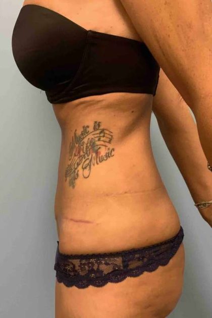 VASER Liposelection Before & After Patient #10643