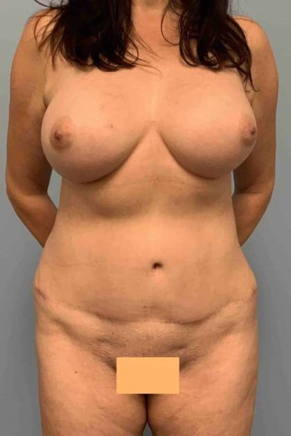 VASER Liposelection Before & After Patient #10670