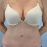 Tummy Tuck Before & After Patient #10675
