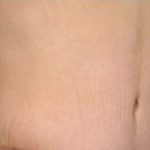 Tummy Tuck Before & After Patient #10689