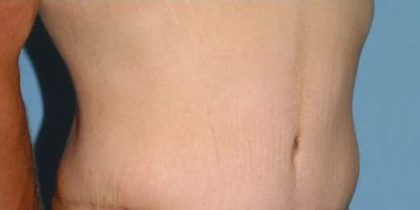 Tummy Tuck Before & After Patient #10689
