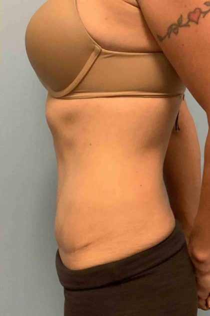 Tummy Tuck Before & After Patient #10721