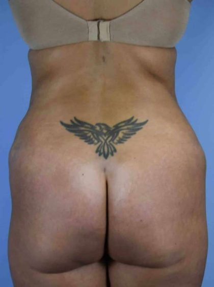 Tummy Tuck Before & After Patient #10742