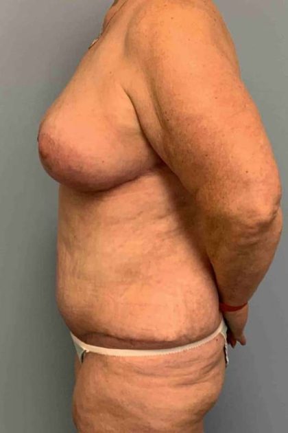 VASER Liposelection Before & After Patient #10391