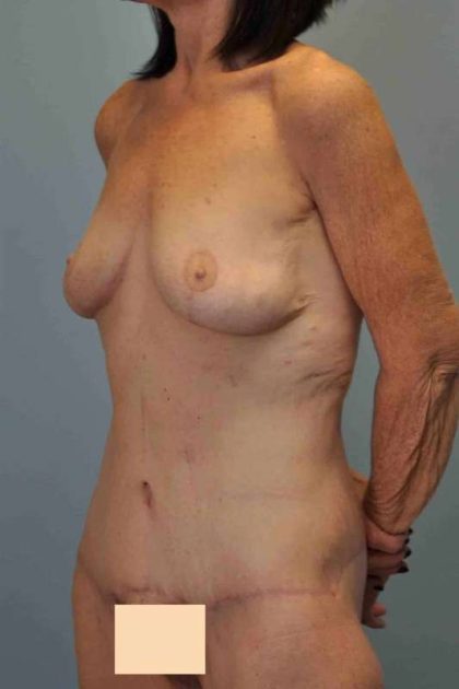 Tummy Tuck Before & After Patient #10793
