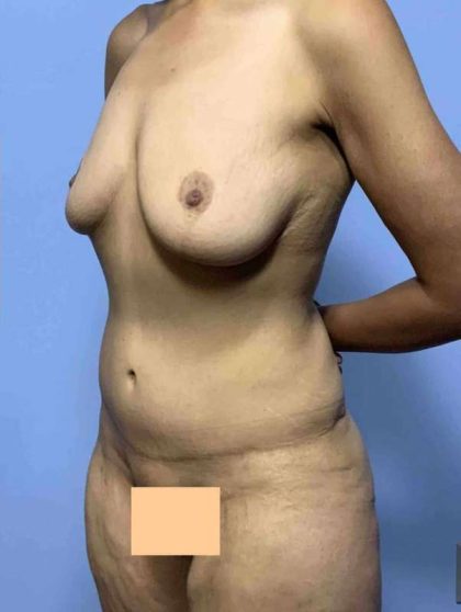 Tummy Tuck Before & After Patient #10807