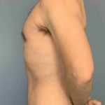 Tummy Tuck Before & After Patient #10832