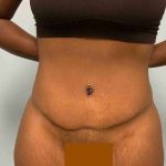 Tummy Tuck Before & After Patient #10839