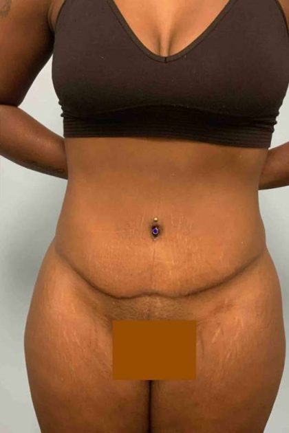 Tummy Tuck Before & After Patient #10839