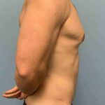 Tummy Tuck Before & After Patient #10846