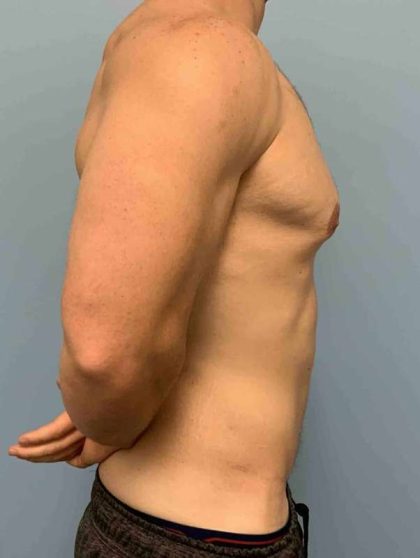 Tummy Tuck Before & After Patient #10846