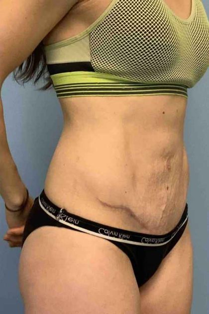 Tummy Tuck Before & After Patient #10862