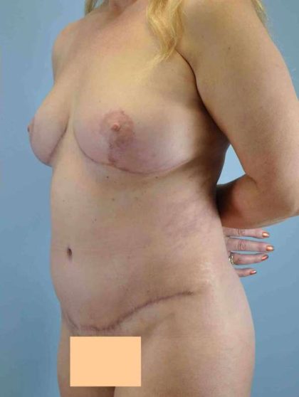 VASER Liposelection Before & After Patient #10384