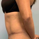 Tummy Tuck Before & After Patient #10869