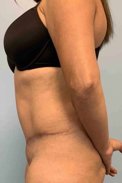 Tummy Tuck Before & After Patient #10869