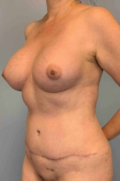 Tummy Tuck Before & After Patient #10874