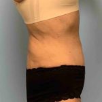 Tummy Tuck Before & After Patient #10881