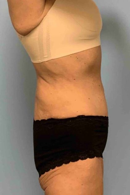 Tummy Tuck Before & After Patient #10881