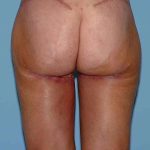 Thigh Surgery Before & After Patient #10890