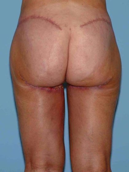 Thigh Surgery Before & After Patient #10890