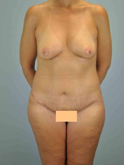 Thigh Surgery Before & After Patient #10900