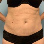 Renuvion Before & After Patient #10921