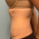 Renuvion Before & After Patient #10928