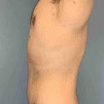 Renuvion Before & After Patient #10944