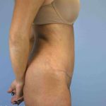Renuvion Before & After Patient #10960